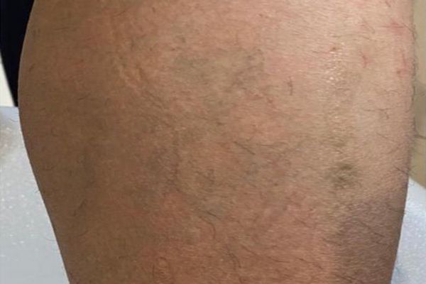 Been tattoo na 4 behandelingen