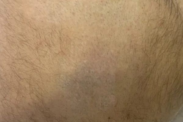 Nektattoo na de laatste behandeling