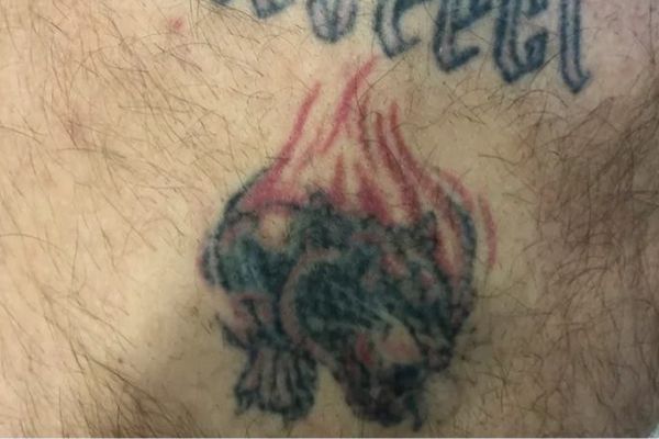 Nektattoo voor de eerste behandeling