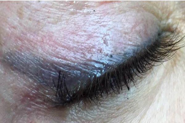 Eyeliner voor de eerste laser behandeling