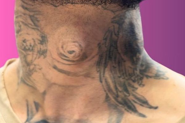 Grote nek tattoo na 3 behandelingen