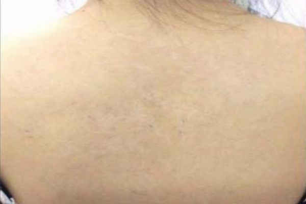Grote rug tattoo verwijderen na de laatste behandeling