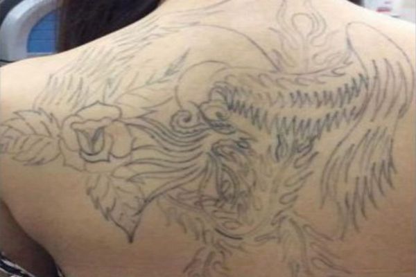Grote rug tattoo verwijderen voor de 1e behandeling