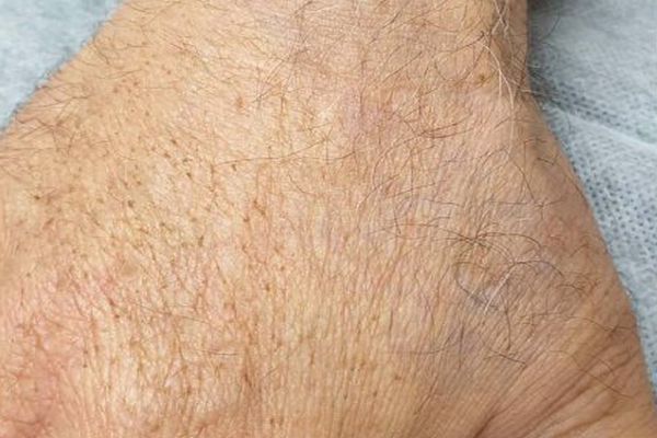 Hand tattoo na de laatste laser behandeling