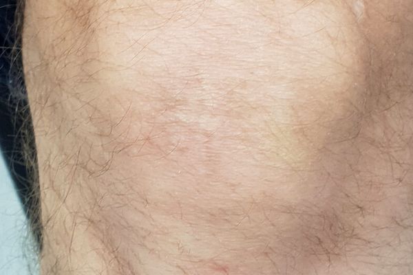 Knie tattoo na de laatste laser behandeling