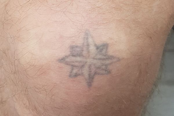 Knie tattoo voor de eerste laser behandeling