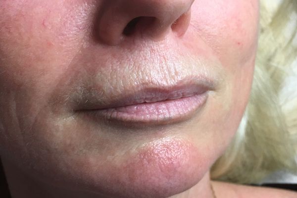 Lipliner net na de laatste laserbehandeling