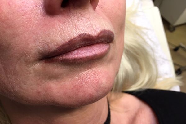 Lipliner voor de eerste laser behandeling