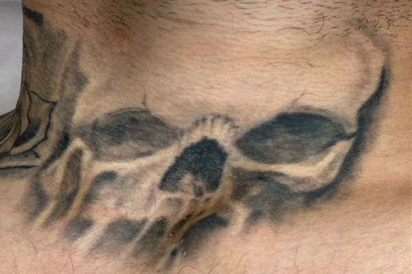Nek tattoo moet verwijderd worden voor onze Engelse klant met onze Picocare laser