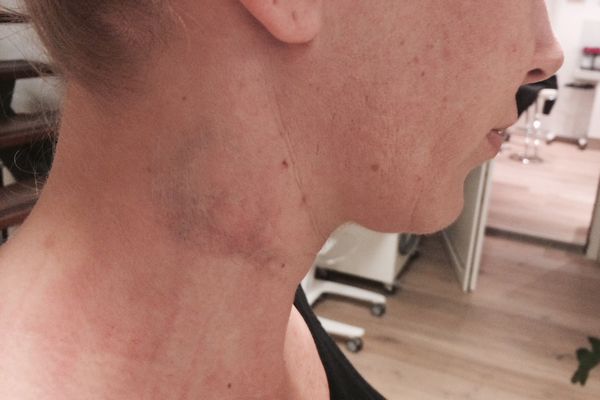 Nektattoo direct na de laatste behandeling