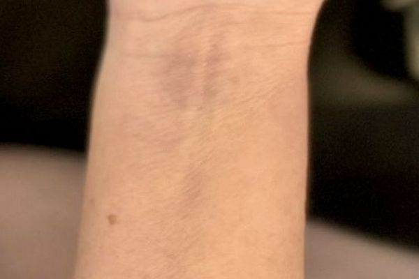 Pols tattoo na de laatste laser behandeling