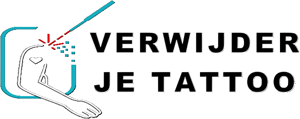 Verwijder Je Tattoo