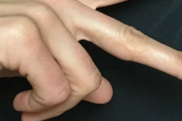 Vinger tattoo na de laatste laser behandeling