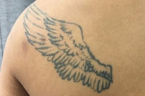 linker schouder tattoo verwijderen voor de behandeling