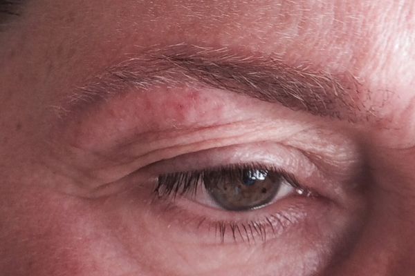 Wenkbrauwen net na de laatste laserbehandeling