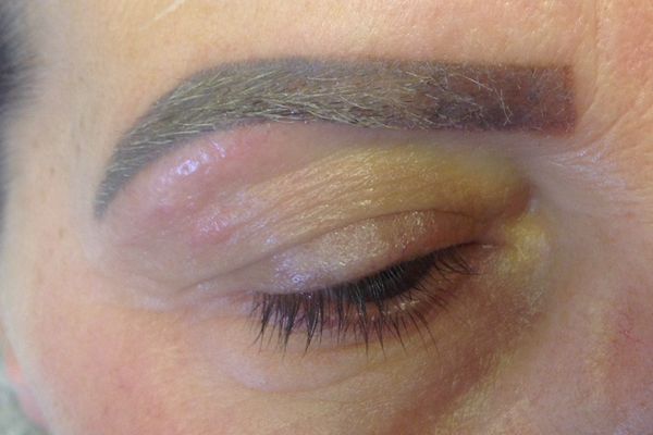 Wenkbrauwen voor de eerste laserbehandeling